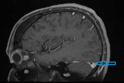 CBR Bradcases - ARMADILHAS NA NEUROIMAGEM: GRANULAÇÃO ARACNOIDE GIGANTE ...