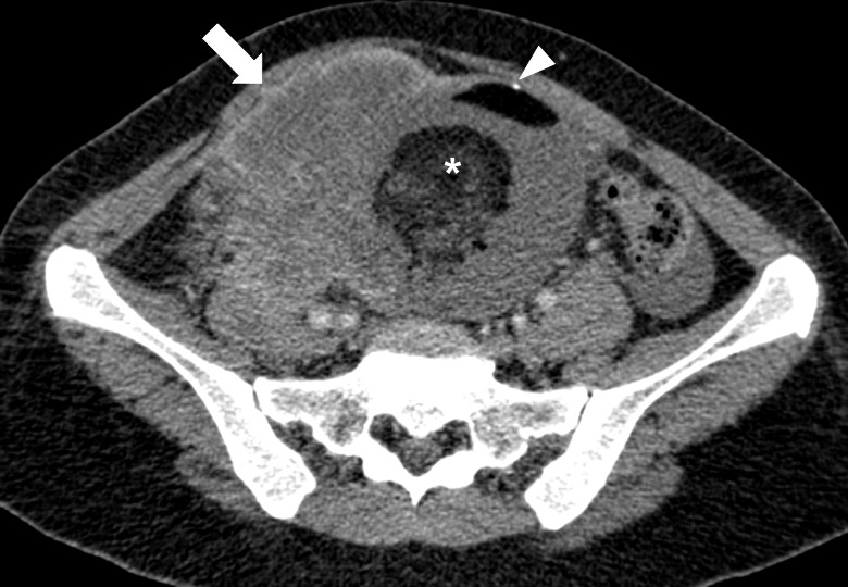 Teratoma de ovário pode se tornar câncer?